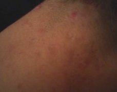 <b>瘰疠艾灸穴位及治疗方法</b>