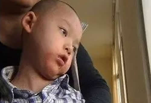 小儿痴呆
