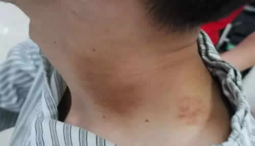 按摩刮痧中风